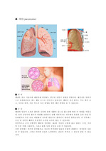 [폐렴] 폐렴에 대해서