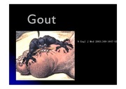 gout (통풍, tophi, gouty arthritis)의 모든 것
