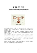 골반염증성 질환  pelvic inflammatory disease (PIH)