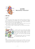 심근경색증(Myocardiac infarction)