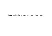 폐 전이암 metastatic cancer to the lung 원인 진단 치료 ppt