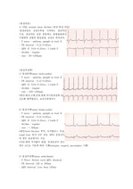 EKG 리듬