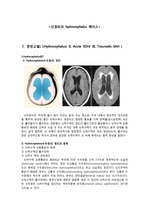 신경계중환자실 케이스  I.Hydrocephalus/ II. Acute SDH/ III. Traumatic-SAH