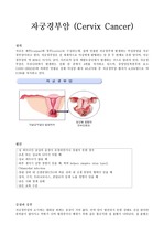 자궁경부암