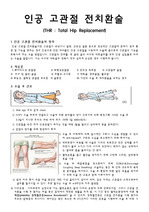 고관절전치환술(THR)