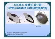 stress-induced cardiomyopathy(스트레스 유발 심근증)