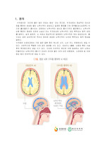 수두증, hydrocephalus