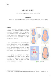 [강추자료]태변 흡인 증후군, MAS