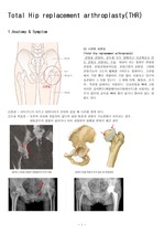 Total Hip replacement arthroplasty(THR)