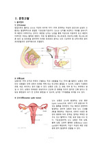 난소낭종