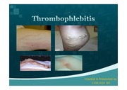 [인기자료]혈전성정맥염(thrombophlebitis) PPT 자료