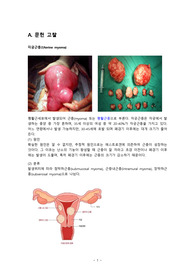 자궁근종(Uterine myoma)  간호과정, 문헌고찰, 케이스