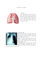 폐렴  조별과제 CASE 입니다. 폐렴에 대한 전반적인 것들이 포함되어 있습니다.