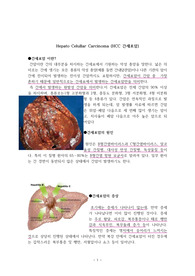 간세포암 문헌고찰