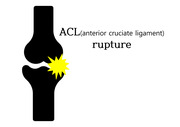 ACL rupture 발표용 ppt 및 대본첨부
