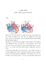 동맥관 개존증 (PDA)