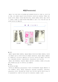 아동케이스 -pneumonia