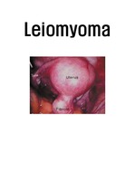 여성간호학 자궁근종 Leiomyoma 케이스