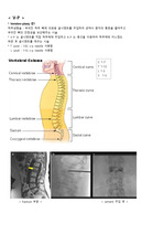 vertebroplasty