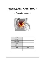 [A+]전립선암(Prostate cancer) 케이스!(간호진단4개, 간호과정4개)