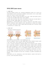 케이스 스터디 척추관협착증