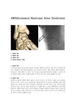 ANS(Accessory Navicular Bone Syndrome)