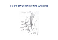 장경인대 증후군(Iliotibial Band Syndrome)