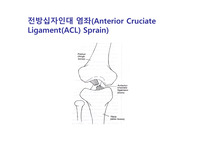 전방십자인대 염좌(Anterior Cruciate Ligament(ACL) Sprain)