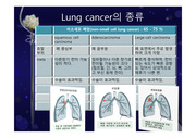 lungcancer종류 및 stage