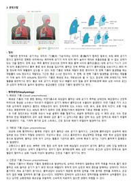 A++ 성인간호학실습&lt;기흉, Pneumothorax&gt; 케이스스터디 진단 &lt;5&gt; 과정&lt;3&gt; - 교수님 피드백 반영