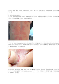 무좀(백선)의 원인, 증상, 치료 및 무좀약 부작용