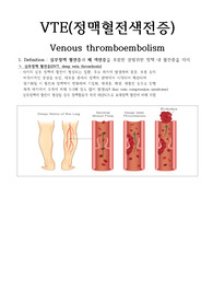 VTE(Venous thromboembolism, 정맥혈전색전증) 문헌고찰