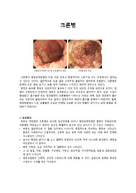 크론병 질병스터디
