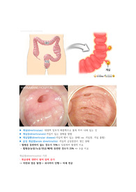 게실염 원인,증상,진단, 기전, 치료방법