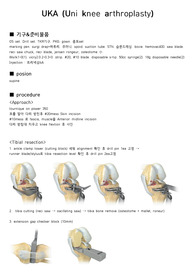 zimmer uni UKA 부분치환술  수술과정 정형외과수술 uni knee arthroplasty