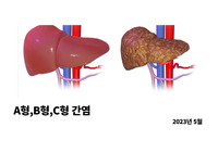 A형간염, B형간염, C형간염 교육 (예방,주의, 병원내 감염 교육)