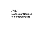 AVN(대퇴골두무혈성괴사) 정형외과병동컨퍼런스, 케이스스터디, 논문참조하여만듦