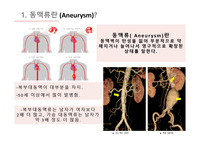 성인간호학-순환기간호 동맥류 발표 피피티 자료 (의미부터 간호중재까지 전부 다 있습니다.)