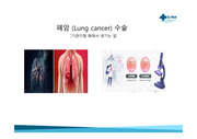 폐암치료