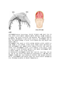 (성인간호)경막하 출혈 문헌고찰 및 간호진단 6개