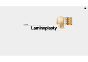 cervical laminoplasty 컨퍼런스 자료
