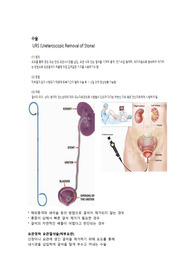 요관경하요관절석술