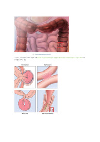 장폐색 간호