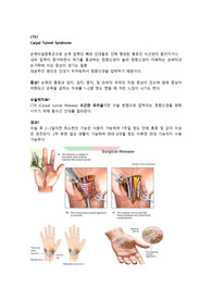 손목터널 증후군 수술