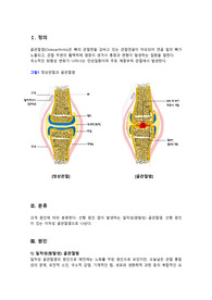 골관절염(Osteoarthritis) 질병고찰 보고서