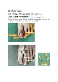 내성발톱 수술