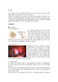 난소종양(ovarian tumors) case study, 모성간호학